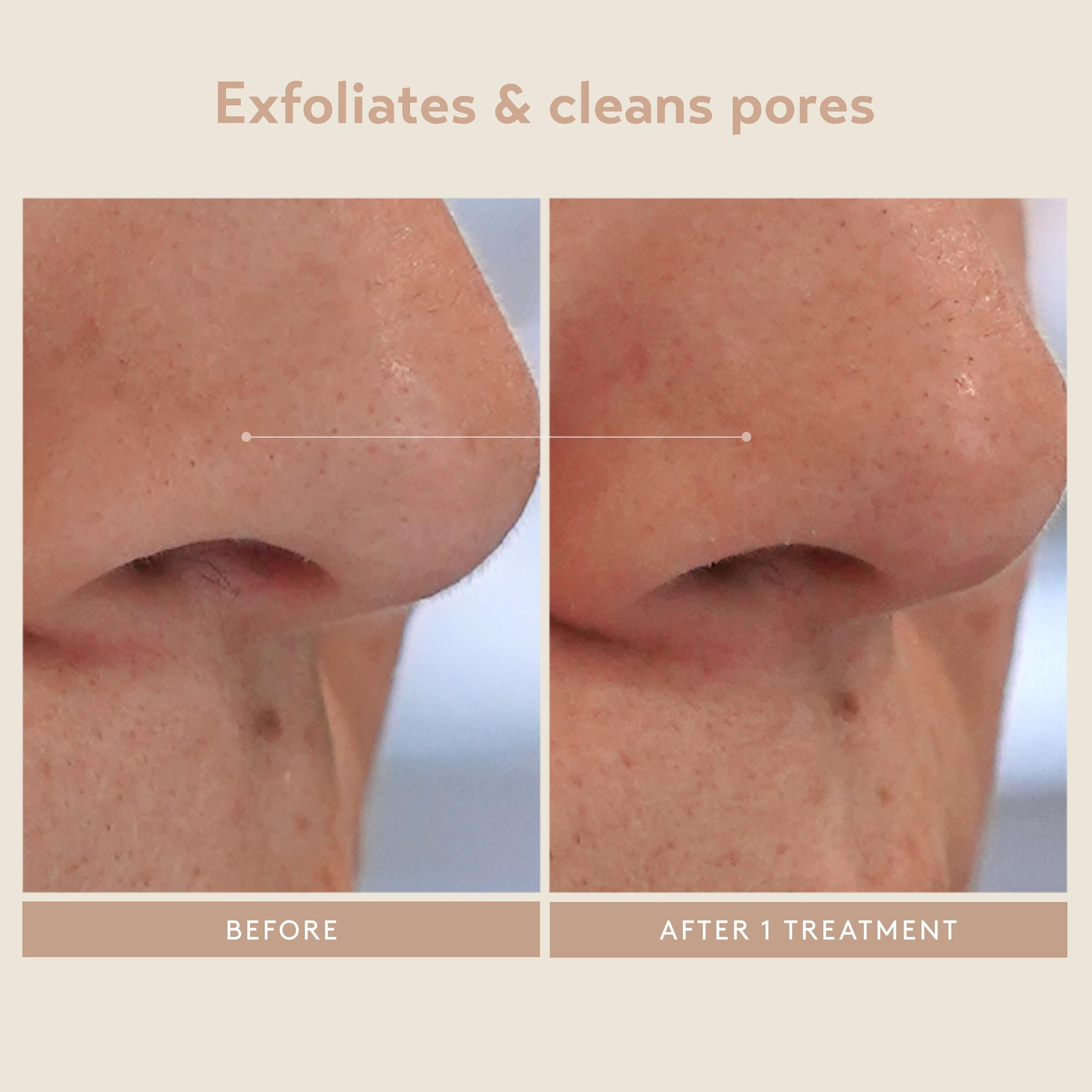 Shani Darden Triple Acid Peel brush included for easy at-home treatment.