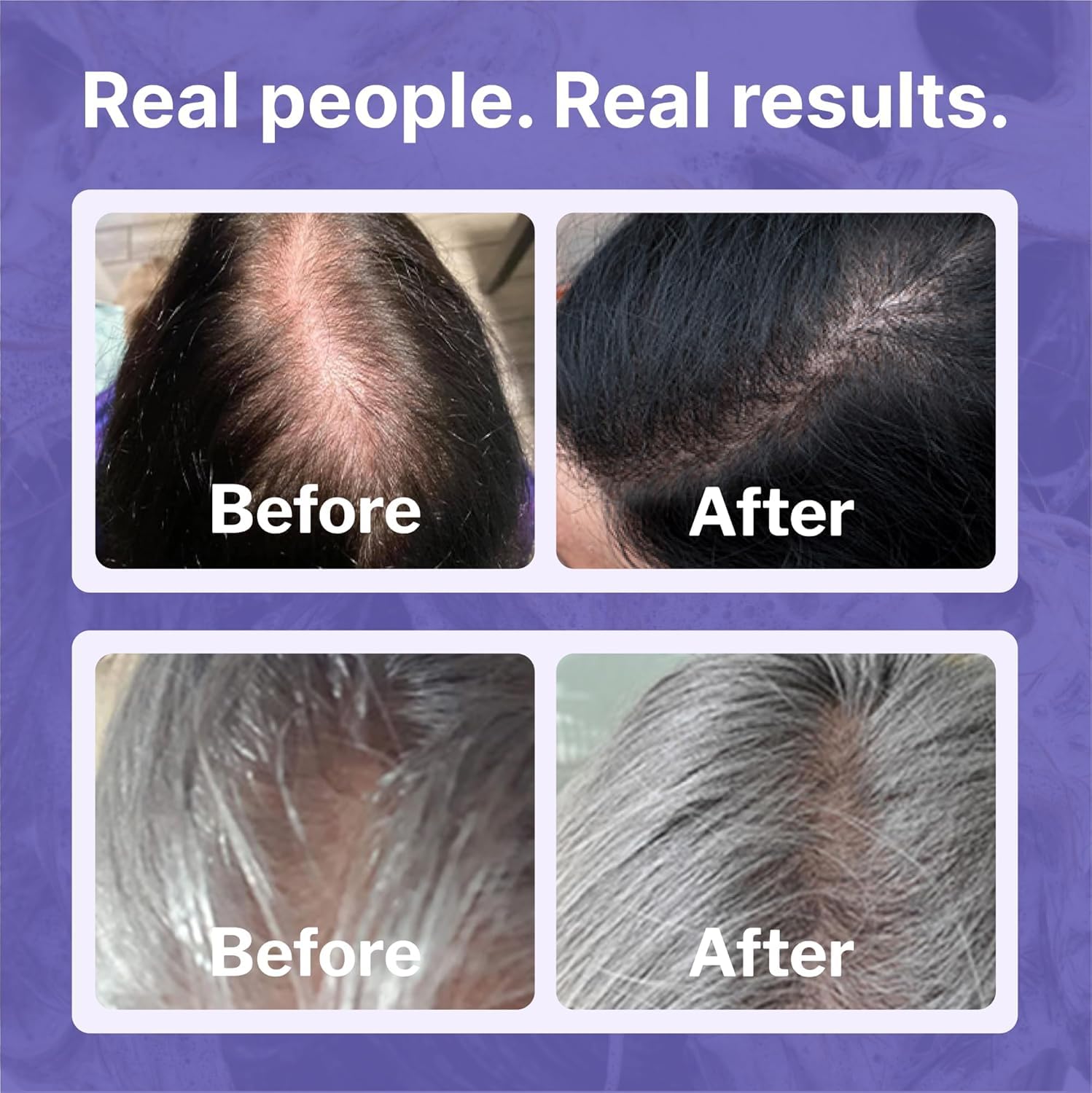 Shapiro MD Minoxidil bottle label displays clear usage guidance.