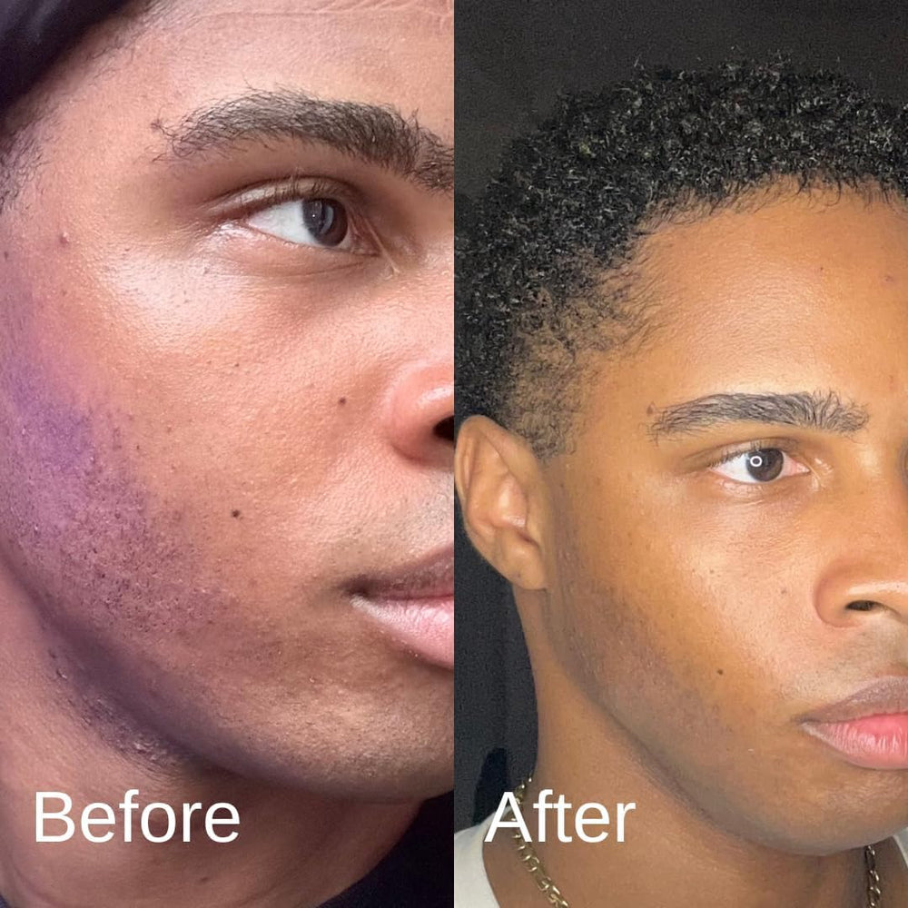 Shield Acne System usage guide on packaging promotes a quick 30-second routine