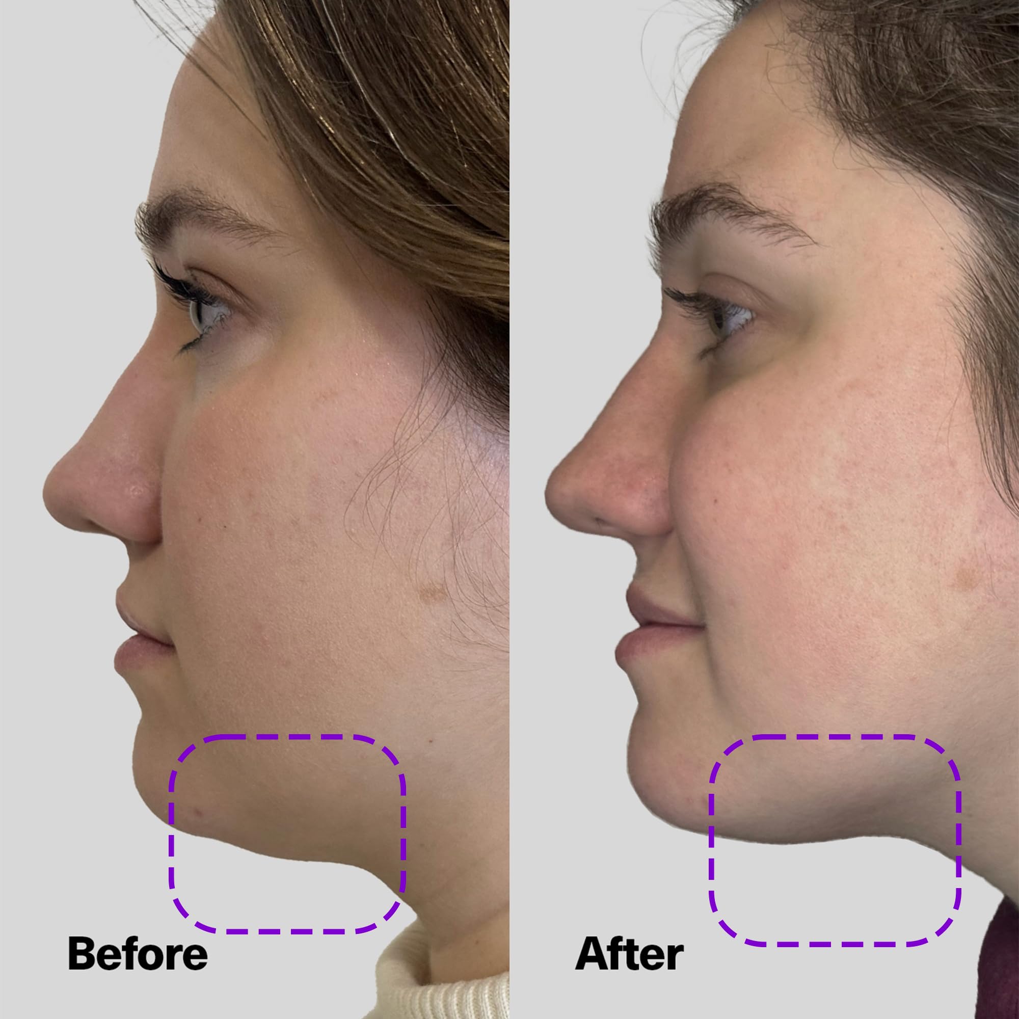 SickScience ShapeShift jawline sculpting application demonstrating V-line refinement.
