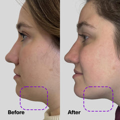 SickScience ShapeShift jawline sculpting application demonstrating V-line refinement.