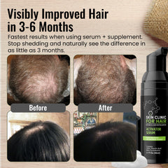 Skin Clinic for Hair foaming serum applied to the scalp for nourishment.