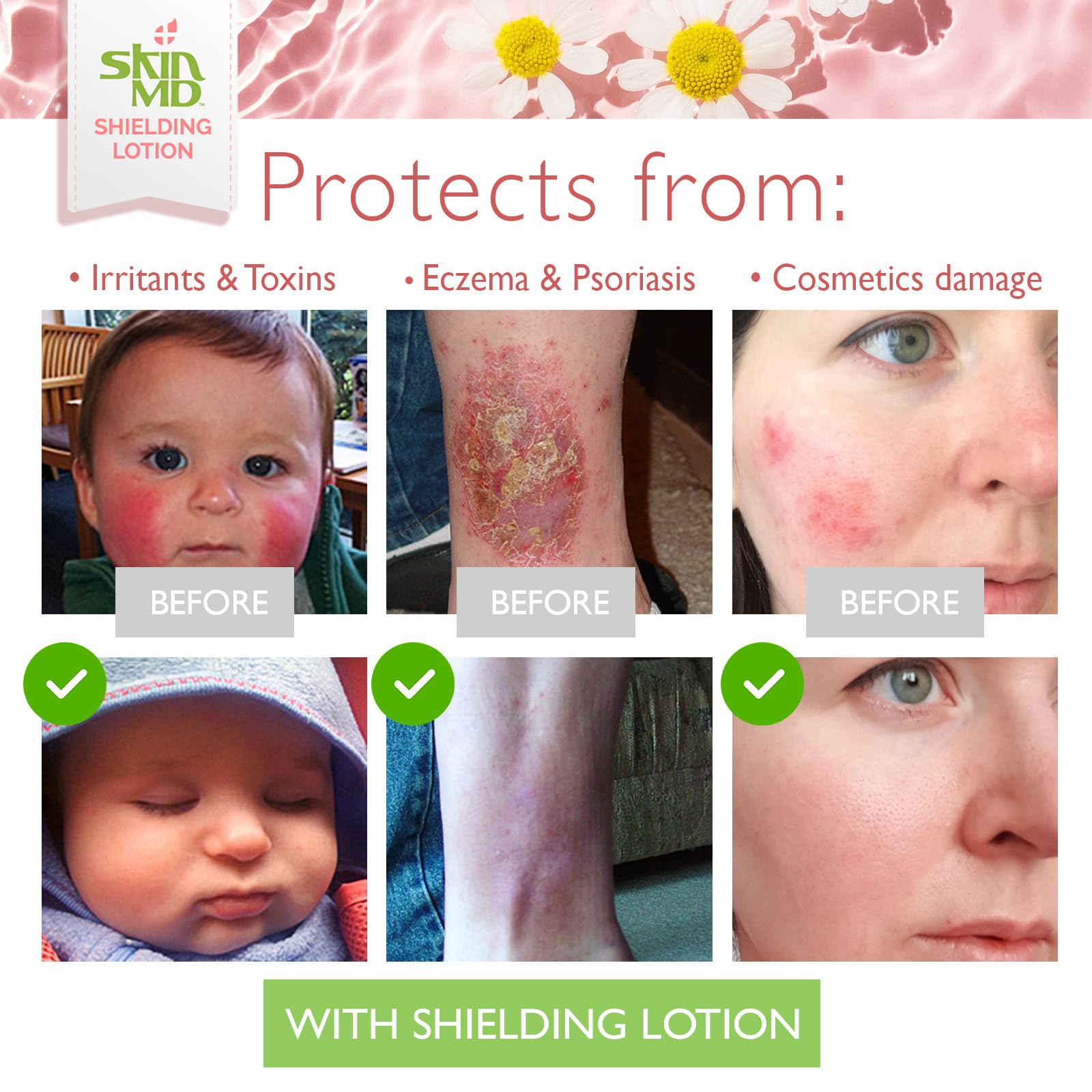 Plant-based ingredients in Skin MD Natural Shielding Lotion: Aloe Vera, Chamomile, Arnica