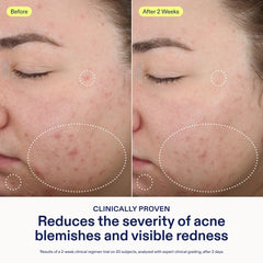 Skinfix azelaic acid reduces redness and promotes even tone.