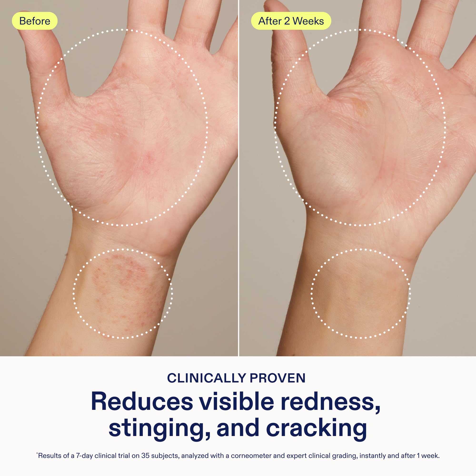 Skinfix Hand Relief Cream jar closeup with non greasy texture