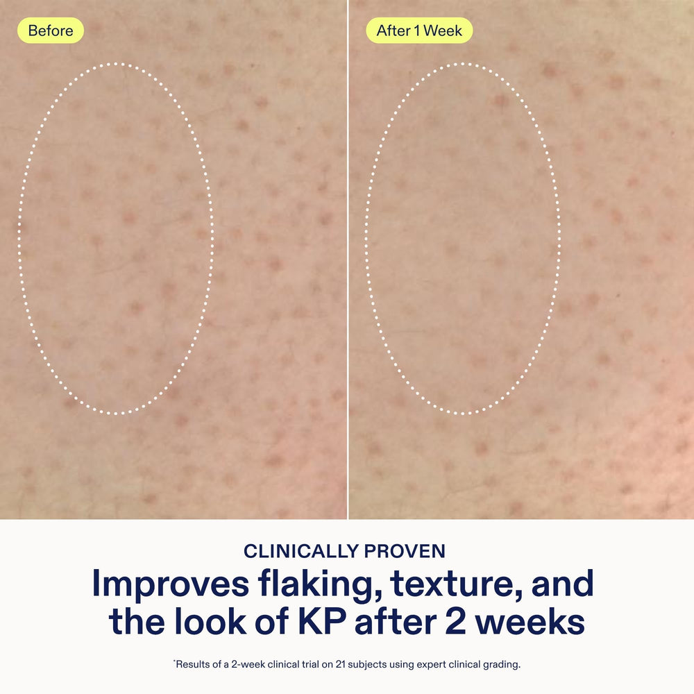 Applying Skinfix KP + PsO Smoothing Body Treatment to damp skin after a shower