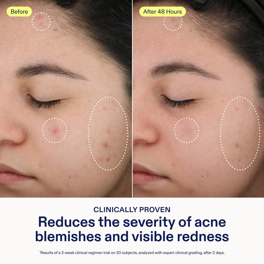 Skinfix spot treatment on clean skin ready to improve clarity.