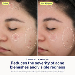 Skinfix spot treatment on clean skin ready to improve clarity.
