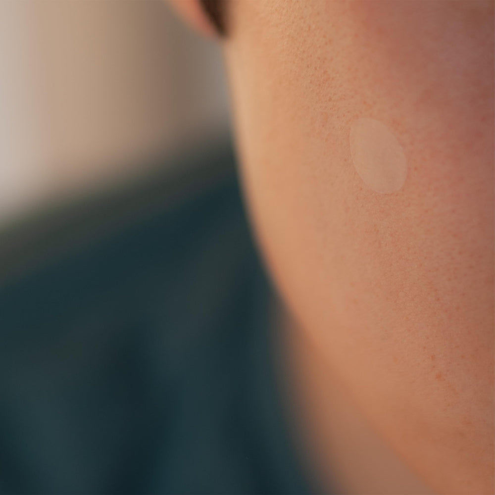 SMARTMED Cover-Dot patches applied to skin for discreet blemish coverage
