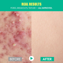 Smilebloom KKOCH Snail Hero Complex 85% image suggests brightening potential.