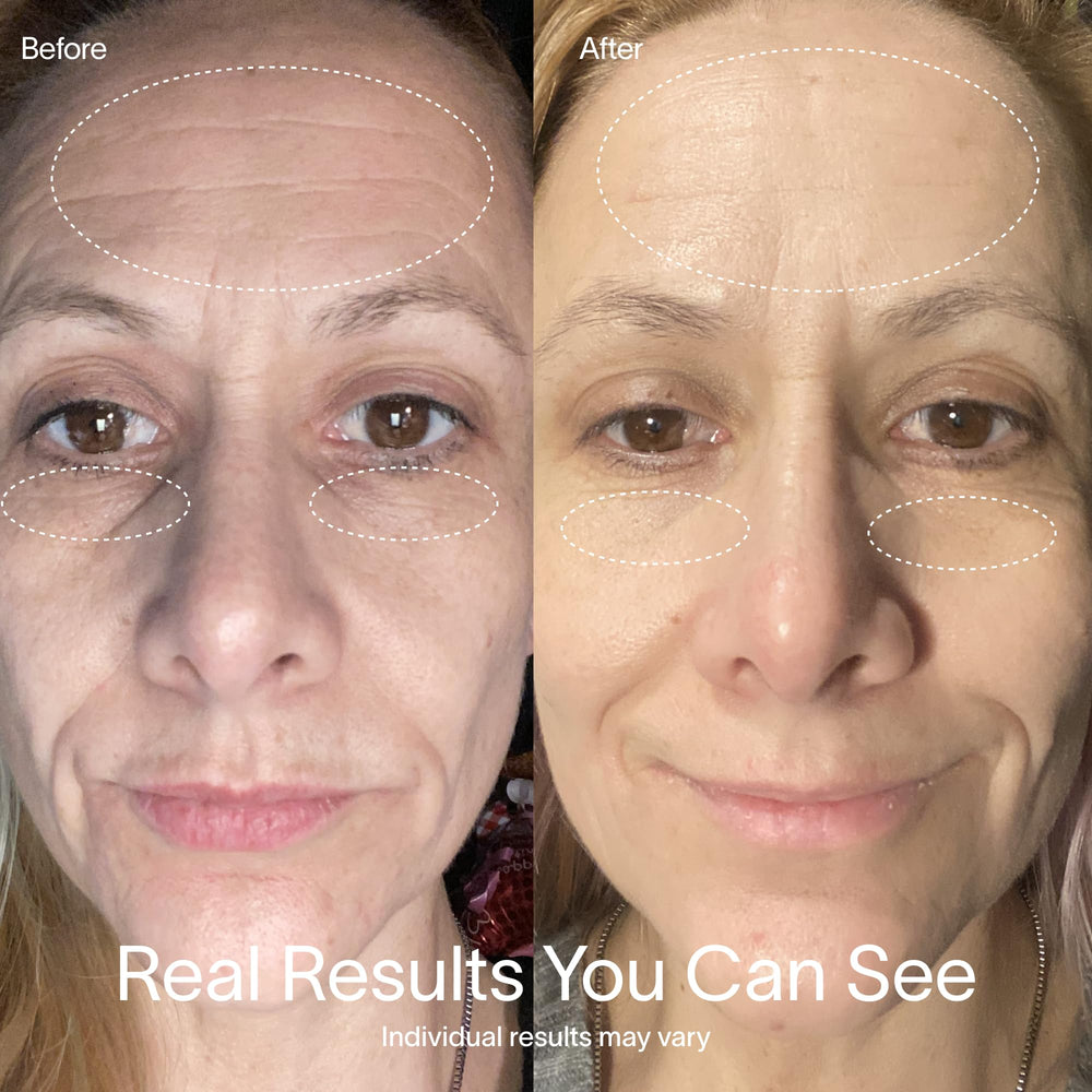 Solawave face therapy in a 10-minute session