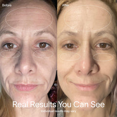 Solawave face therapy in a 10-minute session