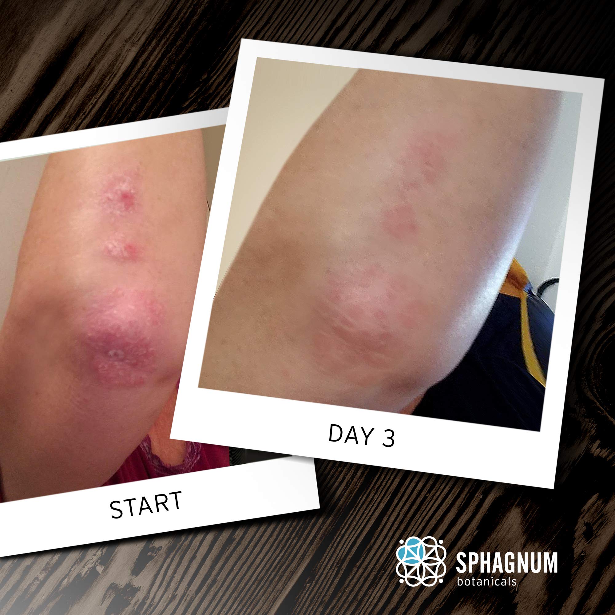Sphagnum Botanicals psoriasis-relief image suggesting soothing cleanse for itchy skin