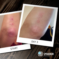 Sphagnum Botanicals psoriasis-relief image suggesting soothing cleanse for itchy skin