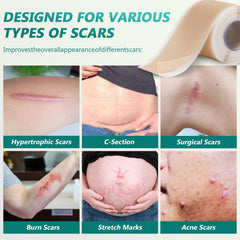 SUCONBE silicone scar tape easy-tear design enables quick trimming without scissors