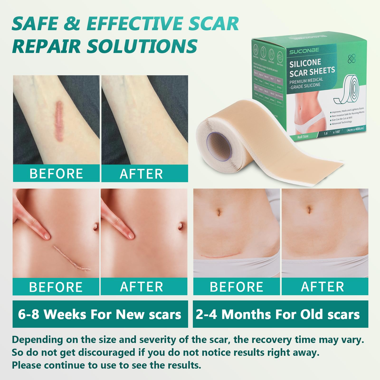 SUCONBE silicone scar tape applied on skin for discreet scar coverage
