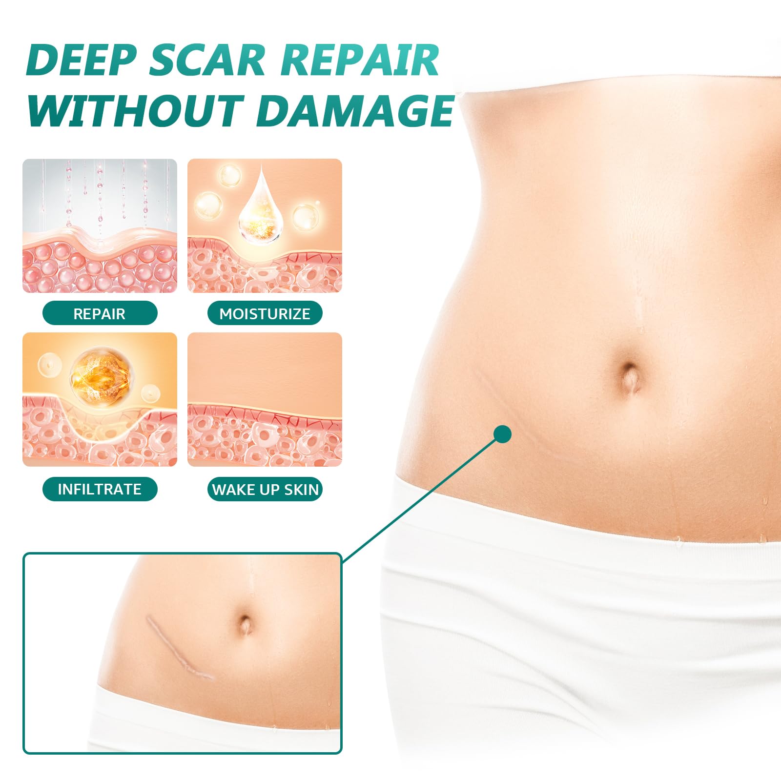 SUCONBE silicone scar tape waterproof design protecting scar area during daily activities