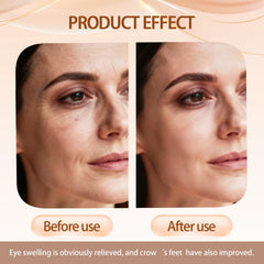 Under-eye puffiness reduced visually after using Sunnydeer Eye Tightener