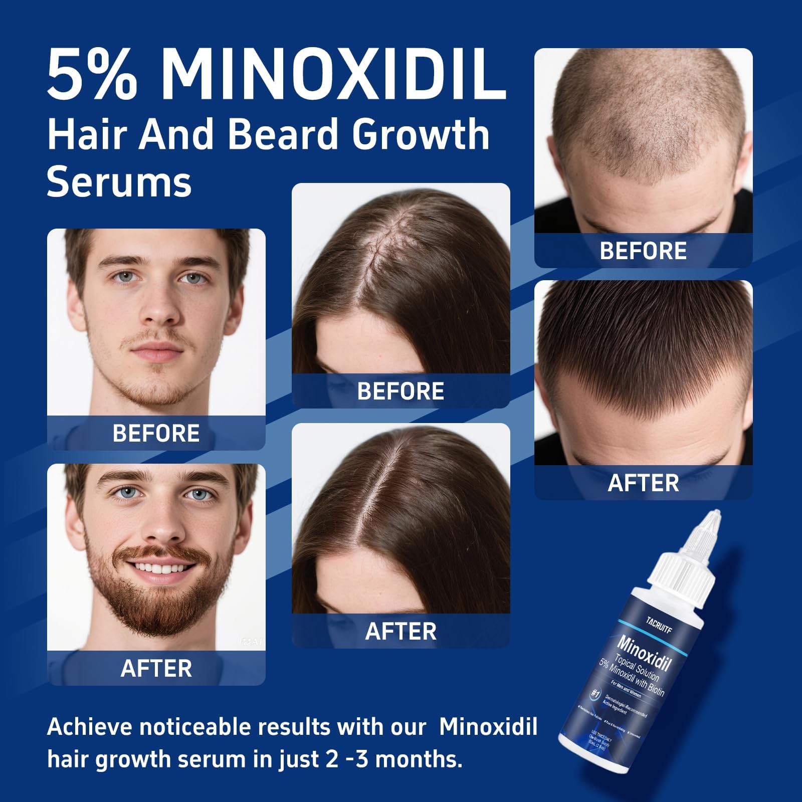 Tacruitf hands applying minoxidil to scalp for home-use hair vitality.