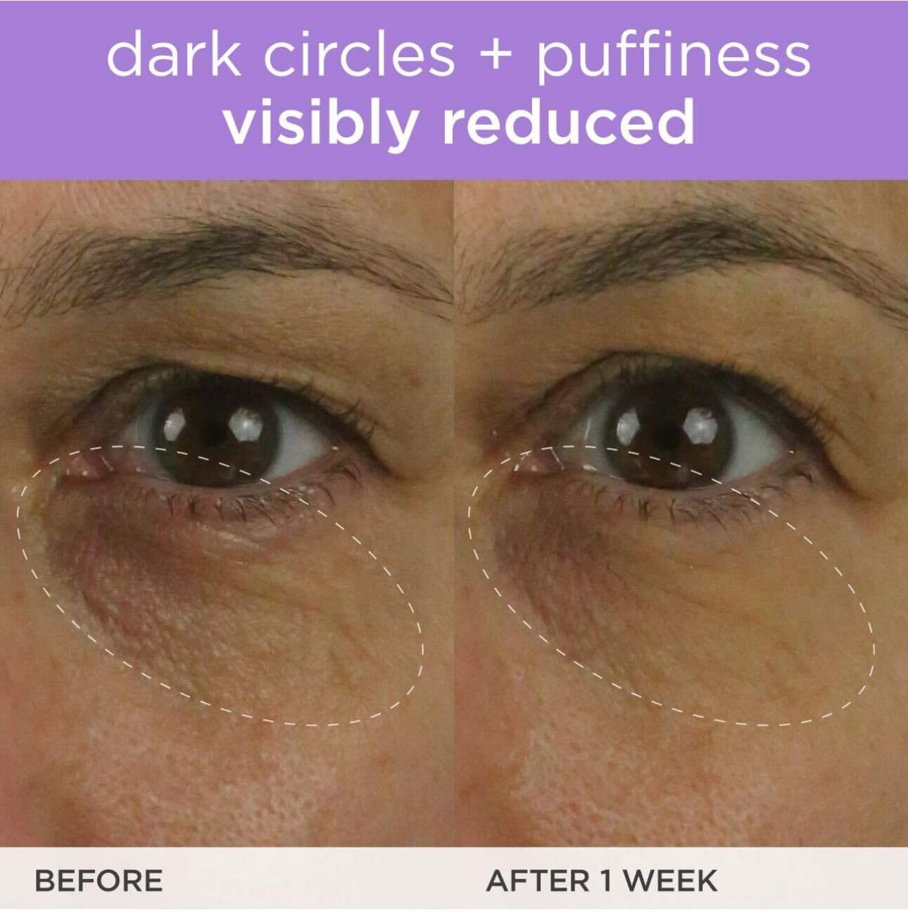 Skin-aligned application of the eye cream on the under-eye area