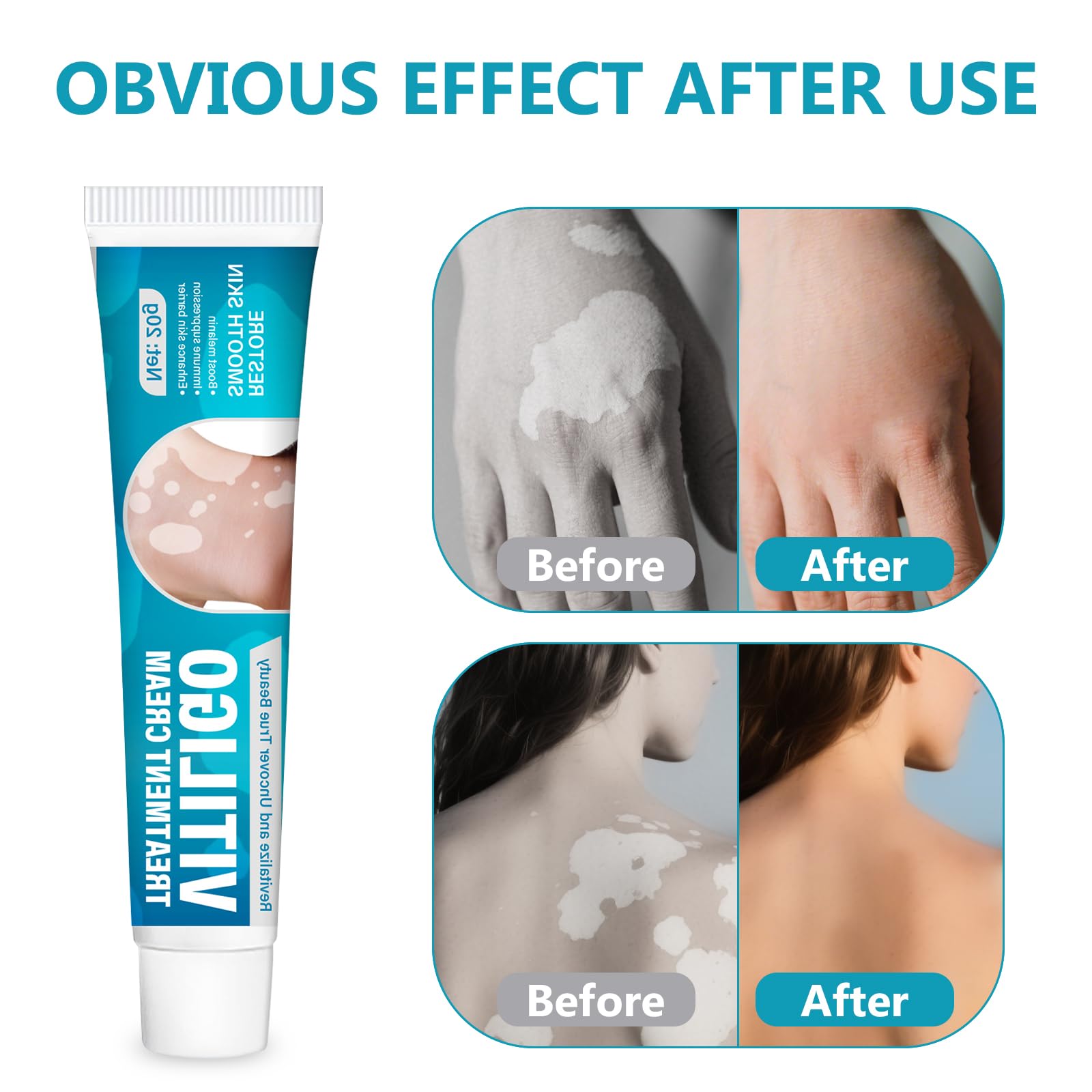 TDZLDM Vitiligo Cream packaging box on a clean surface.