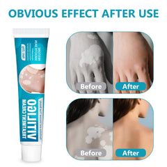 TDZLDM Vitiligo Cream packaging box on a clean surface.