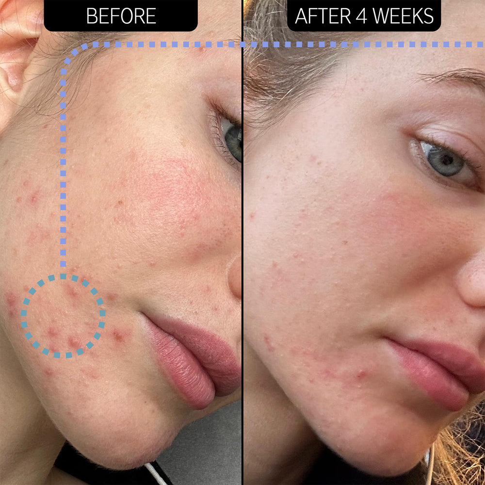 The INKEY List Novoretin 2% Moisturizer label highlighting product purpose for blemish-prone skin