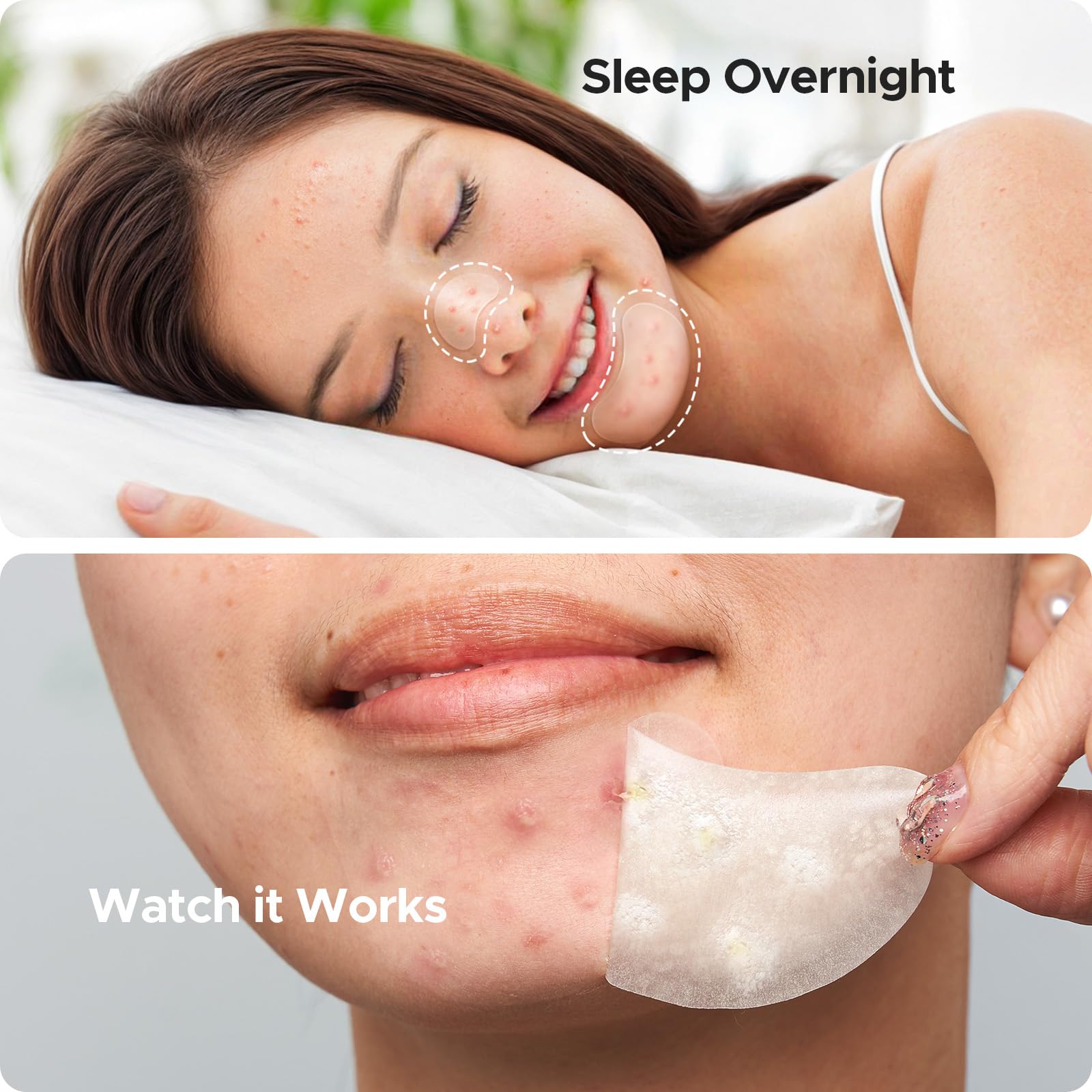 TKTK chin patch size L 38x26 mm half-moon for targeted spots.