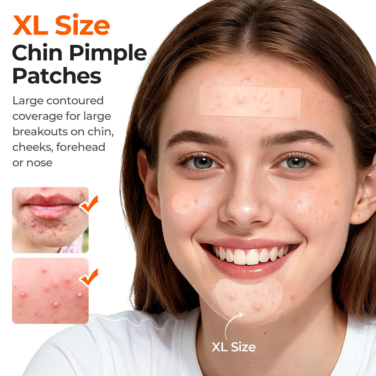 TKTK round acne patches 8–12mm target spots for focused coverage.