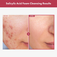 TOSOWOONG Salicylic Acid Foam Cleanser foamy lather demonstrates exfoliation for smoother skin