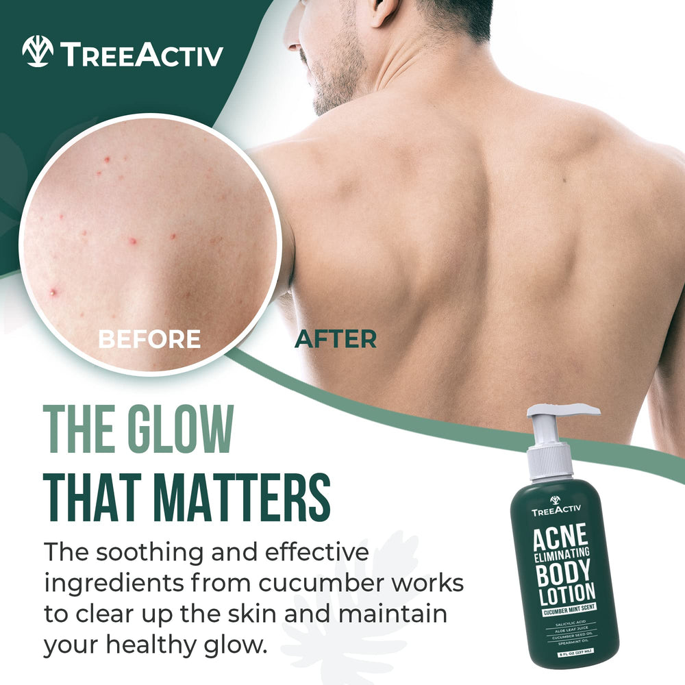 TreeActiv Acne Eliminating Body Lotion label close-up showing tea tree oil and aloe for gentle care.