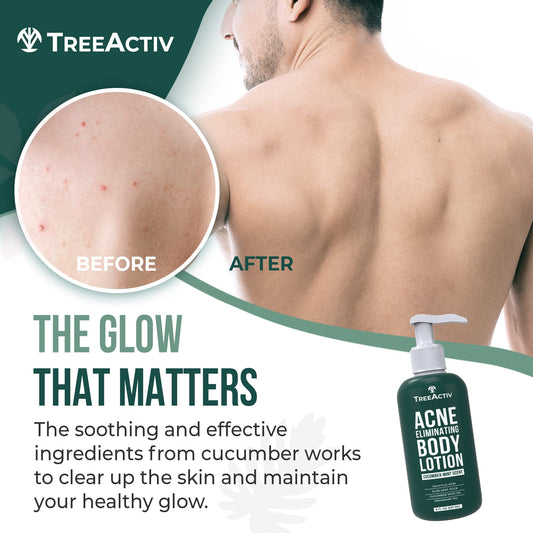 TreeActiv Acne Eliminating Body Lotion label close-up showing tea tree oil and aloe for gentle care.