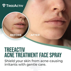 TreeActiv Acne Face Spray mist on face provides quick refresh during busy days.