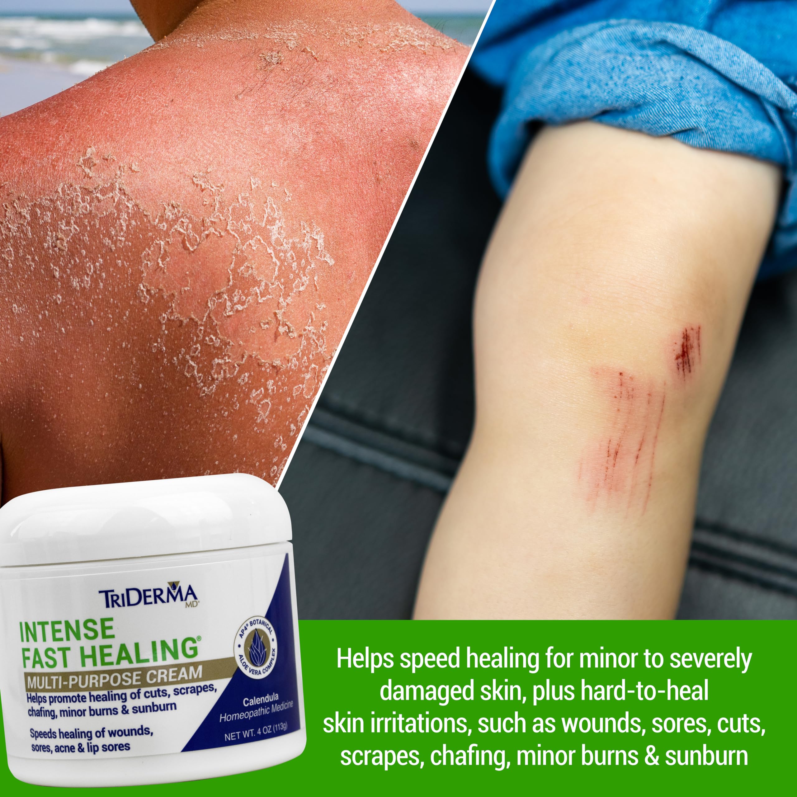 TriDerma Intense Fast Healing Cream application demonstrates easy soothing massage