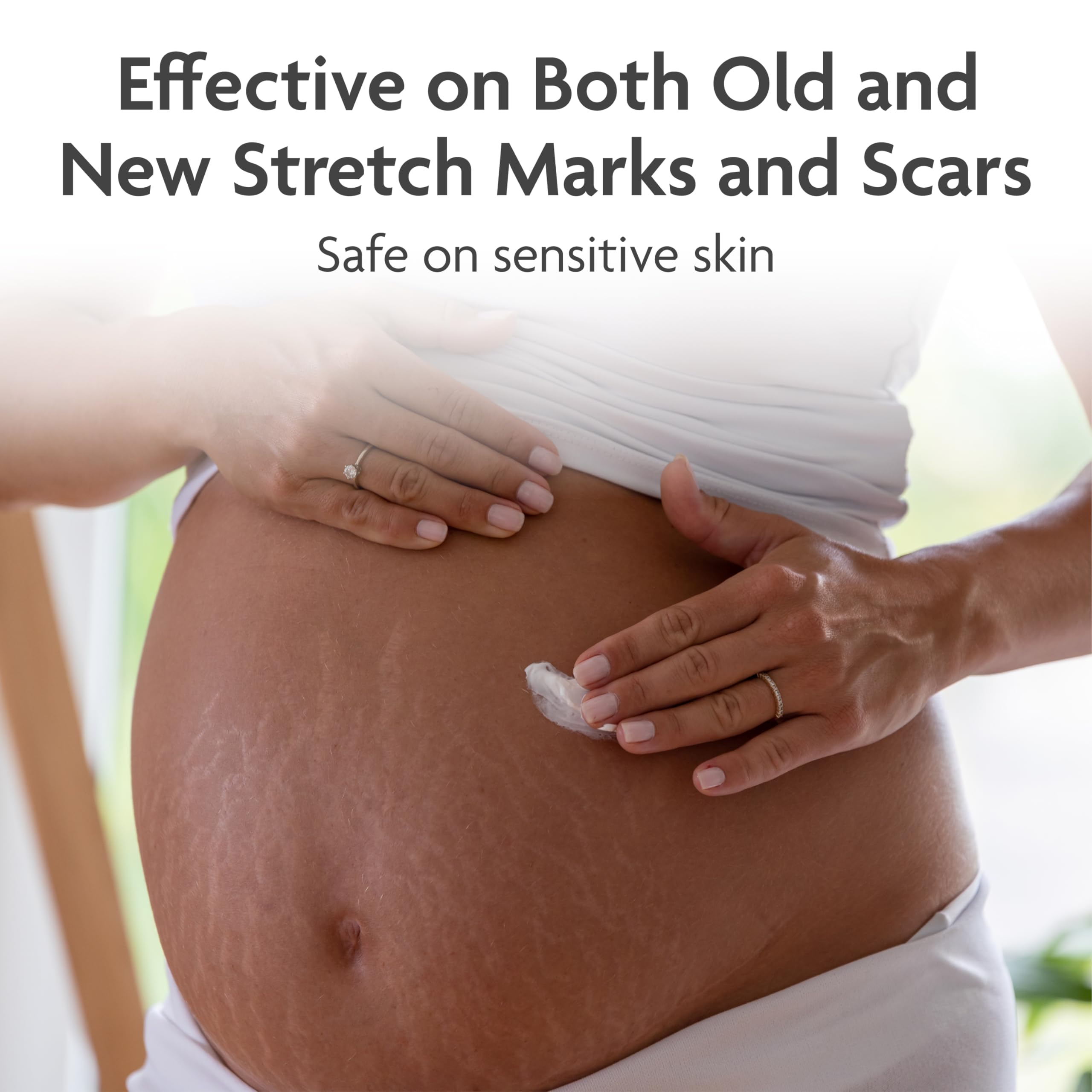 TriLASTIN Stretch Mark Cream being applied to hips and thighs for target care.