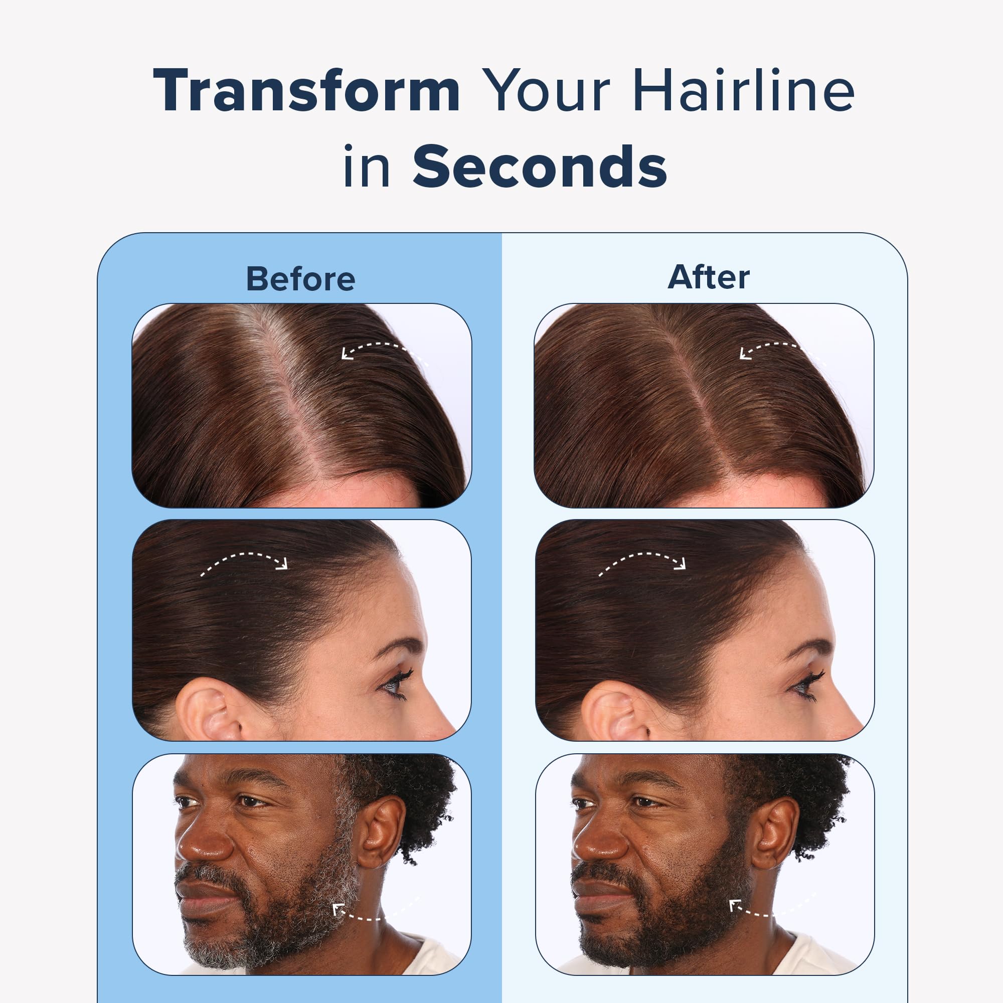Truhair bald-spot cover blends with natural hair for instant concealment.