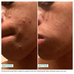 Urban Skin Rx Clear Skin 3-in-1 bar as mask left on face up to 3 minutes.