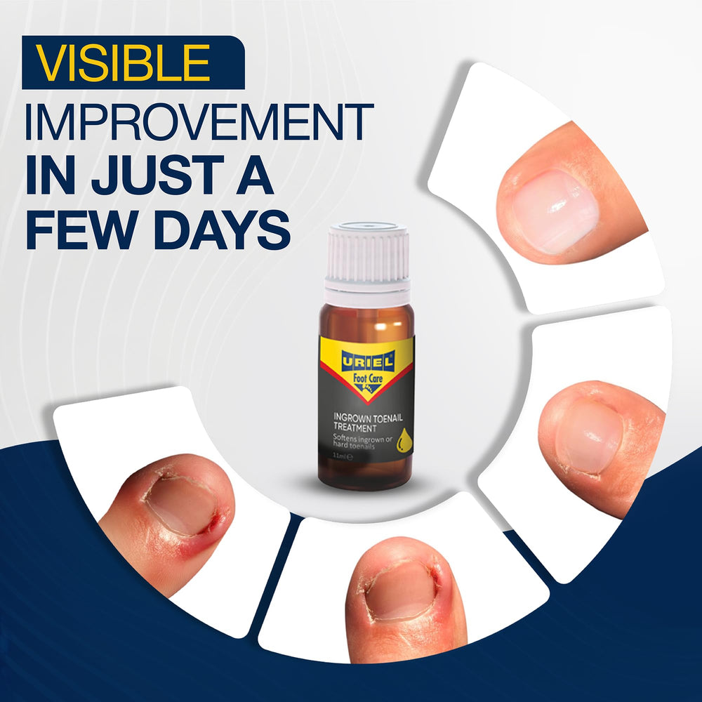 URIEL two silicone toe caps fit all sizes for versatile at home care.