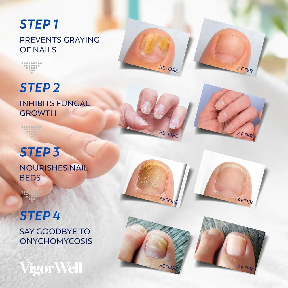 VigorWell Extra-strength formula for toenail maintenance