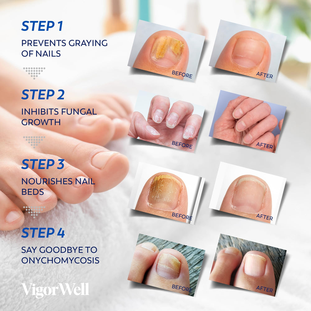 VigorWell skin-tone patch blends with nails for discreet fungal care