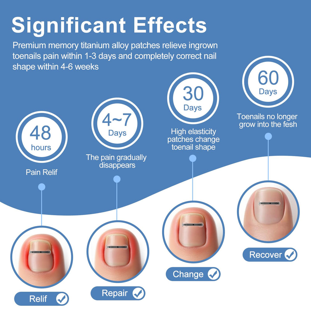 Vitasy size-3 corrector strip designed for curved nails