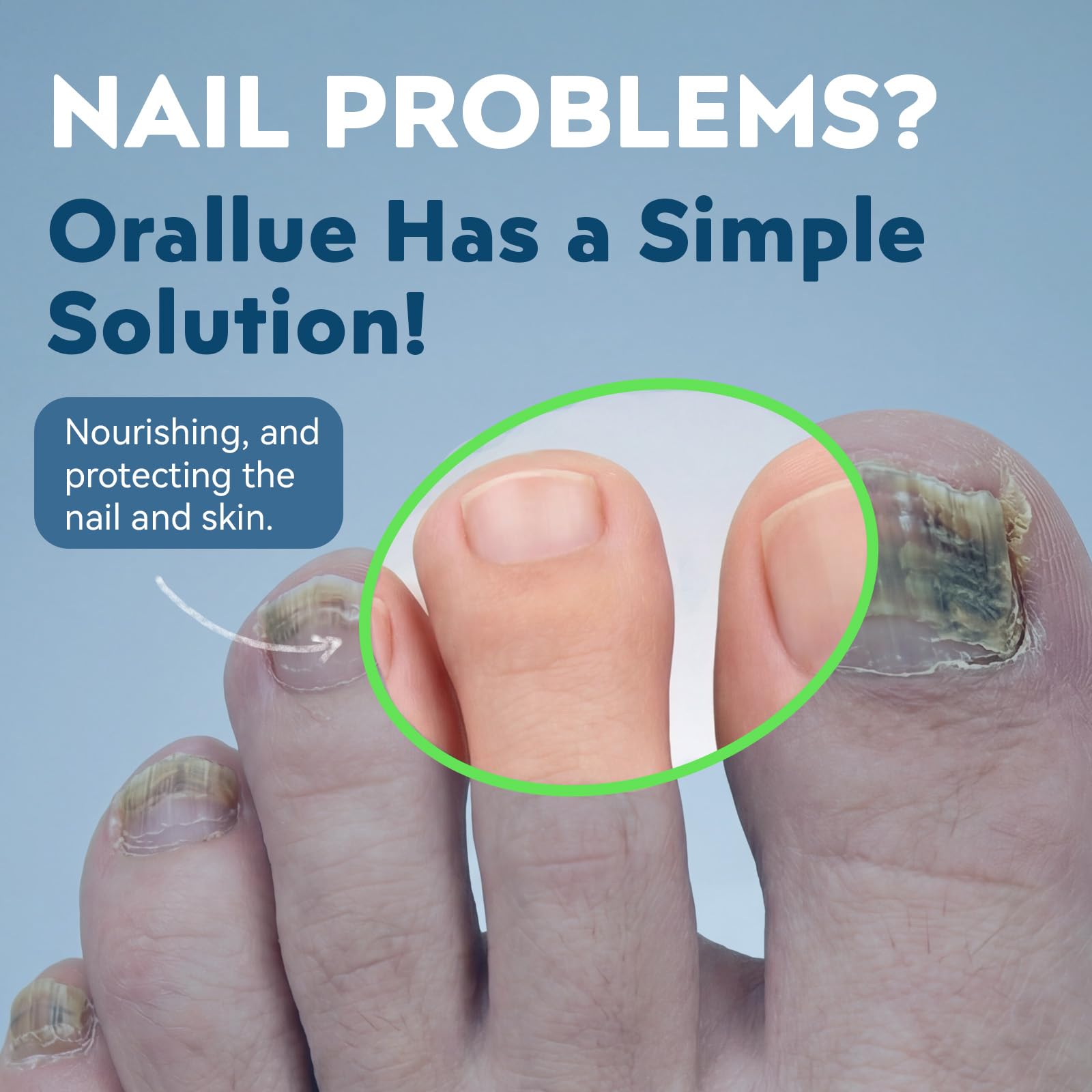 XILRVON Nail Fungus Pen twist design enables precise application around nails