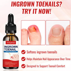 YEQOIZ ingrown toenail corrector with lever mechanics aligns nail growth.