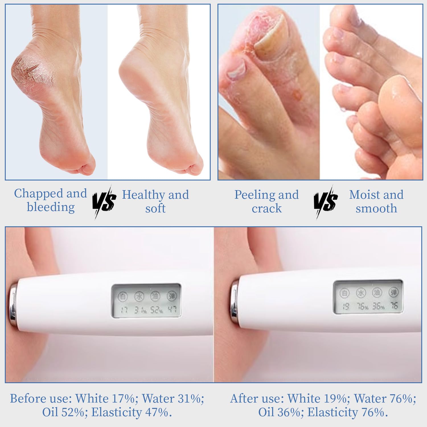 YOUNGYOUNGLOVE Urea Cream 70% with hyaluronic acid for lasting moisture.
