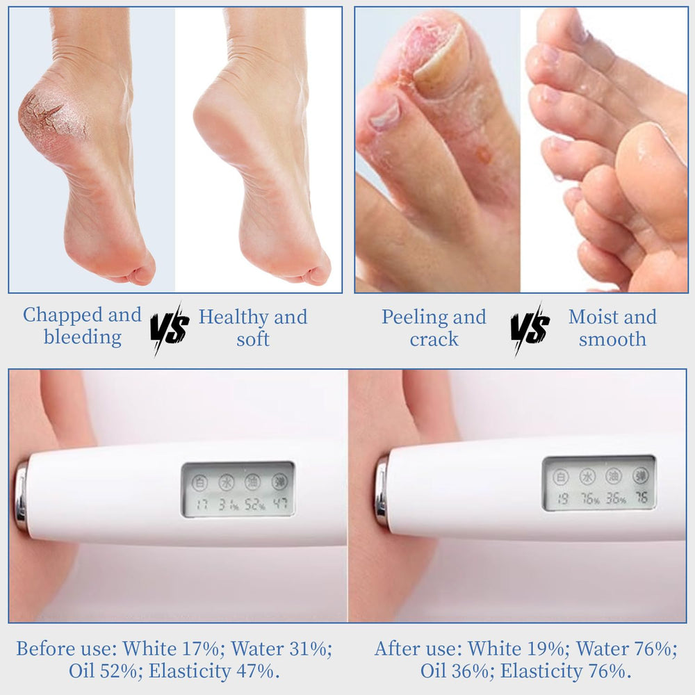 YOUNGYOUNGLOVE Urea Cream 70% with hyaluronic acid for lasting moisture.