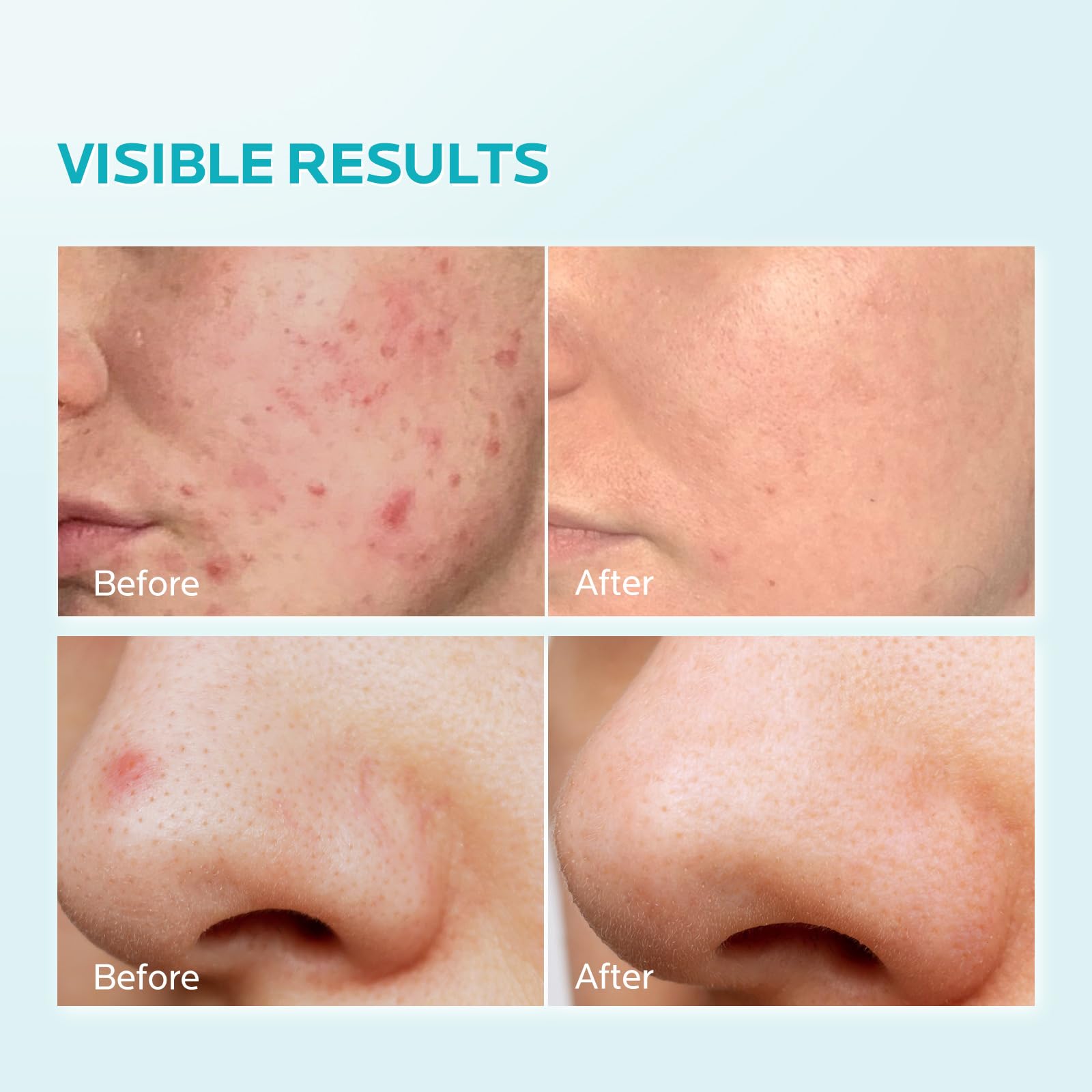 Applying ZealSea azelaic acid cream to the face for breakout relief
