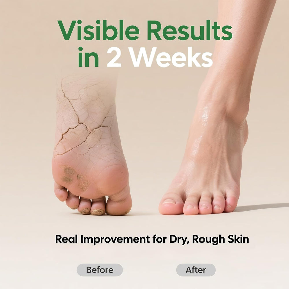 ZyraGloz 60% Urea Cream with salicylic acid; exfoliates calluses gently.